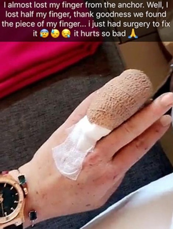 Lindsay Lohan'ın parmağı koptu